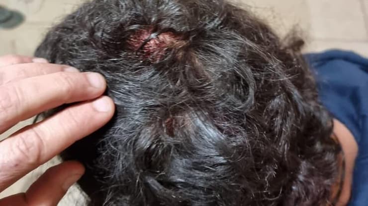 החבלות בראשו של הנער היהודי לאחר שהותקף בידי פלסטיני בהר חברון