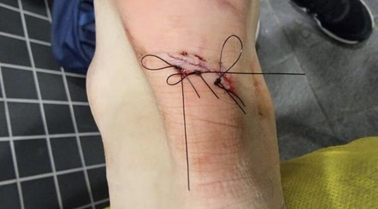 הרגל הפגועה של דן ביטון