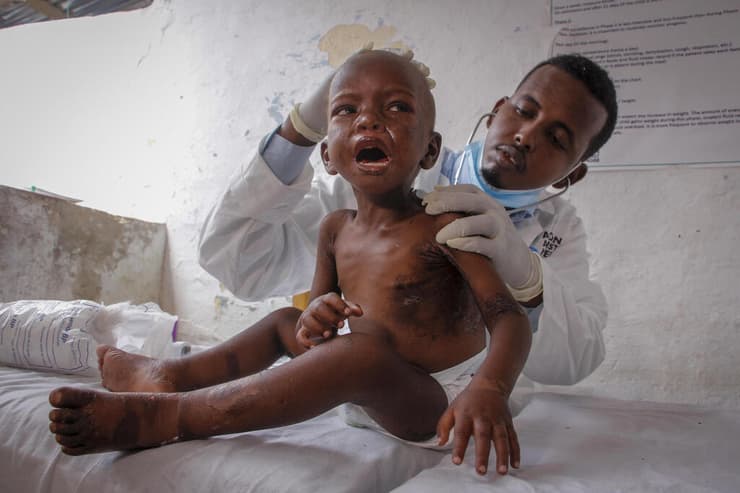 סומליה רעב משבר מזון מרכז לטיפול ב תת תזונה מוגדישו ד"ר מוסטף יוסוף מטפל ב עלי עוסמאן בן 3
