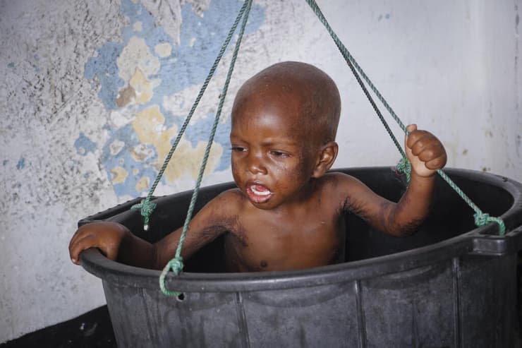 סומליה רעב משבר מזון מרכז לטיפול ב תת תזונה מוגדישו עלי עוסמאן בן שלוש