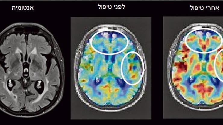 הדמיית MRI של מוח לפני ואחרי טיפול בתא לחץ