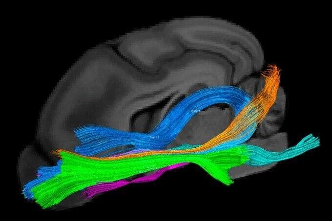 MRI למוח