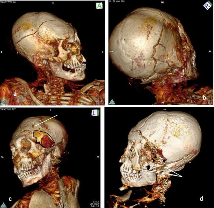 סריקת CT תלת ממדית של גולגולת המומיה הזכרית מהמוזיאון לאמנות והיסטוריה בדלמונט, בה ניתן לראות את הפגיעה בה כתוצאה מאלימות אכזרית ומכוונת