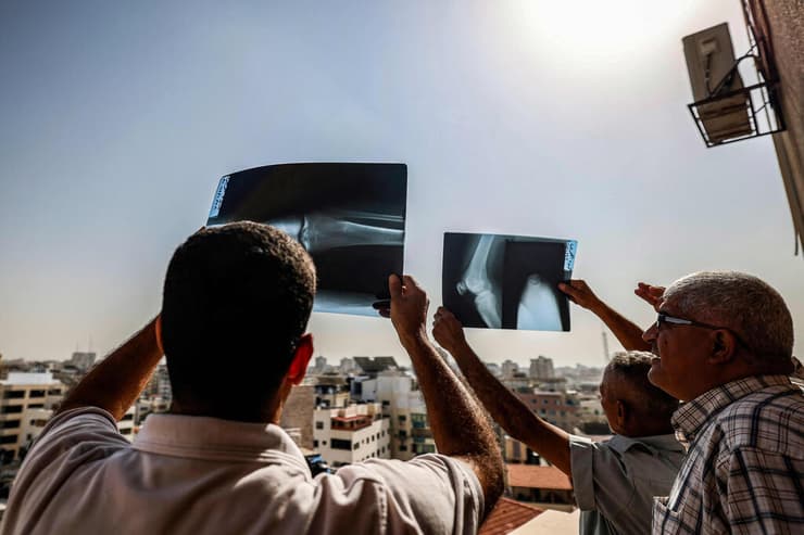 צילומי רנטגן כהגנה בצפייה בליקוי בעיר עזה