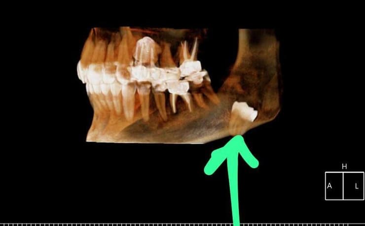 שן בינה בגרון CT