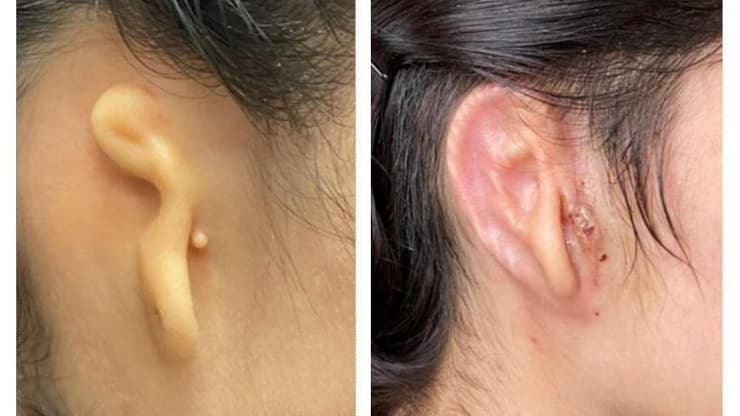 לפני ואחרי ניתוח השתלת האוזן 