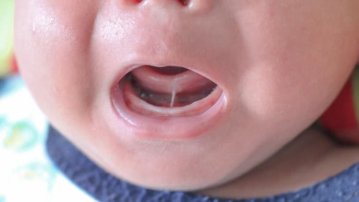 לשון קשורה שן שיניים פה חלל הפה