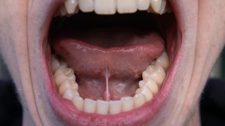 לשון קשורה שן שיניים פה חלל הפה