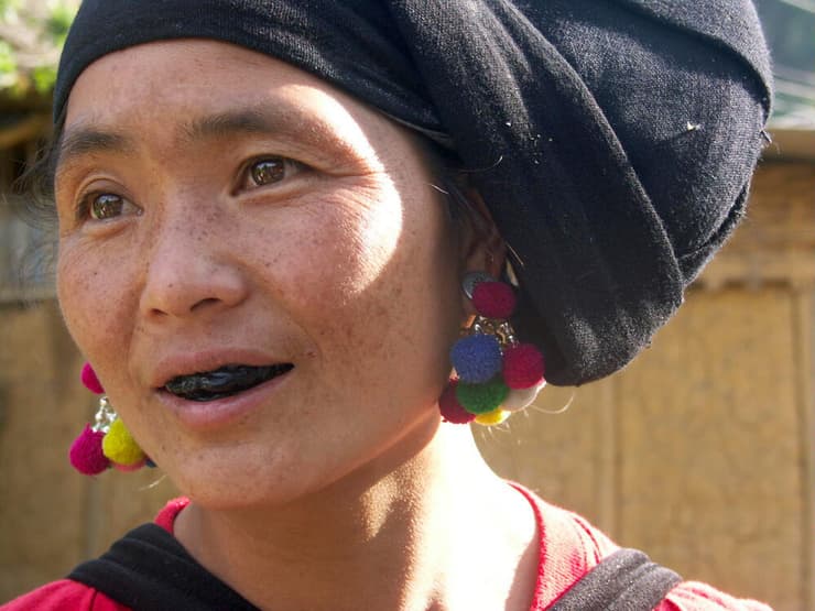 אישה בווייטנאם שעברה השחרת שיניים