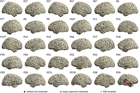     כיסוי האלקטרודות במוחותיהם של 29 מטופלים. הנקודות האדומות מייצגות אלקטרודות שהגיבו למוזיקה