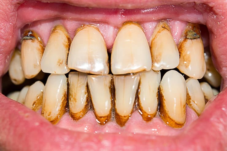 נזקי עישון סיגריות לשיניים