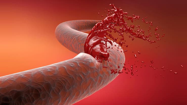הדמיית דימום מכלי דם אצל חולי המופיליה