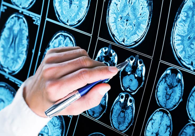 בדיקת הדמיה של המוח אפילפסיה