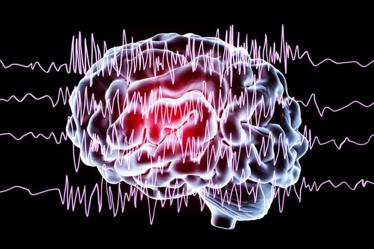 הפרעה חשמלית כתוצאה ממחלת אפילפסיה