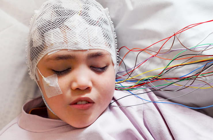 בדיקת EEG לחולת אפילפסיה