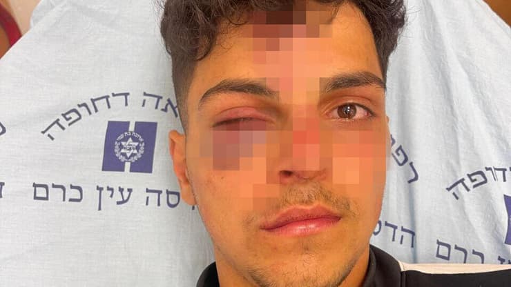 תושב מזרח ירושלים בן 16 הוכה באלימות קשה על ידי קבוצת גזענים וכוחות משטרה