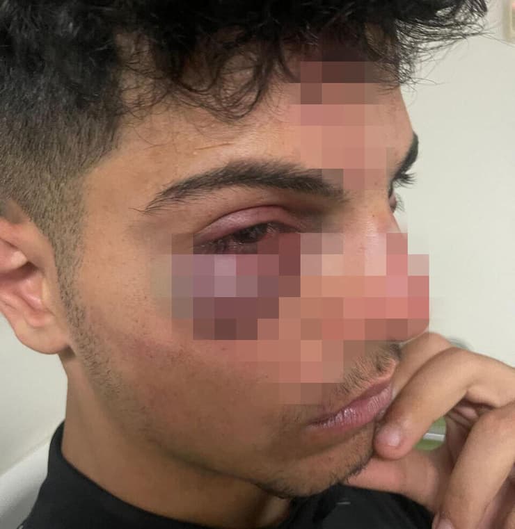 תושב מזרח ירושלים בן 16 הוכה באלימות קשה על ידי קבוצת גזענים וכוחות משטרה