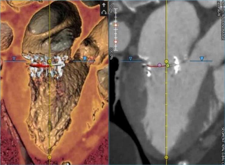 תמונת CT בה רואים את המסתם של אינוולב (החלק הלבן) שהושתל בבן-אדם