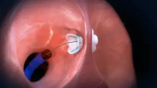 "היה קשה לשכנע את תעשיית ההייטק הרפואית באותה תקופה לגייס כסף לפיתוח". המסתם של חברת ו-וייב (צילום: V-Wave) מסתם ללב של חברת ו-וייב (V-Wave) שנמכרה לחברת ג'ונסון אנד ג'ונסון