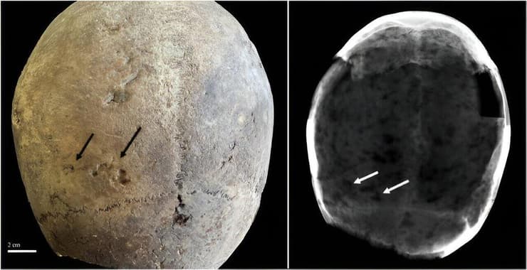 גולגולת של אחד מבין שני האנשים ששרידיהם נותחו והצביעו על שימוש בקוקאין