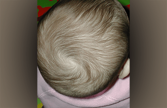 אצל כמה אנשים ספירלת השיער צומחת דווקא נגד כיוון השעון. שיער הראש של בת שנה צומח עם כיוון השעון | צילום: Noj Han, CC BY-SA 2.0, Flickr, via Wikimedia Commons