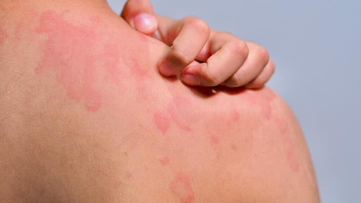 אורטיקריה גורמת לגירודים בעוצמות שונות (צילום: Shutterstock) אורטיקריה, מחלת עור