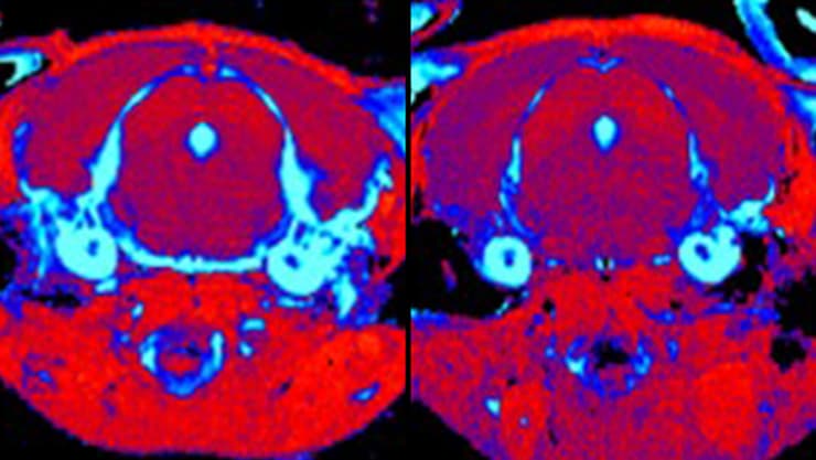 סריקת MRI מוח בעכבר עם מחלת גושה סוג 3 שקיבל טיפול גנטי (מימין) ובעכבר חולה שלא טופל (משמאל). הסריקה חושפת הפחתה משמעותית ברמת הדלקתיות ברקמה שמסומנת בתכלת בעכבר שטופל (צילום: מכון ויצמן למדע) סריקת MRI מוח בעכבר עם מחלת גושה סוג 3 שקיבל טיפול גנטי (מימין) ובעכבר חולה שלא טופל (משמאל). הסריקה חושפת הפחתה משמעותית ברמת הדלקתיות ברקמה (מסומנת בתכלת) בעכבר שטופל