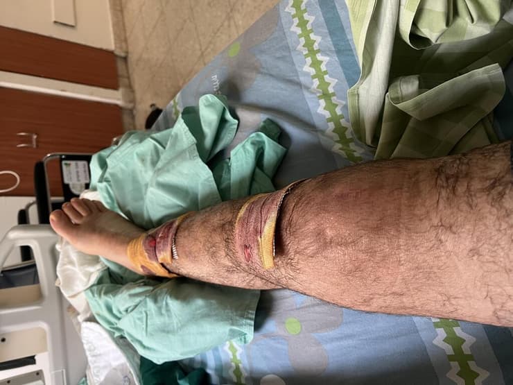 תקופת השיקום של דורון בלחסן לאחר הפציעה ב-7 באוקטובר