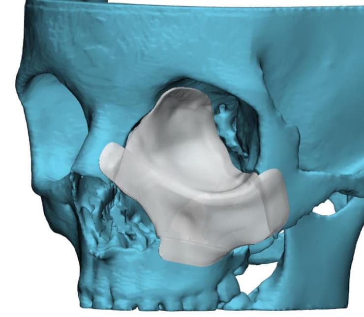 הדמיות על בסיס CT הדמיות ניתוח שחזור ארובת עין סורוקה סער גנור