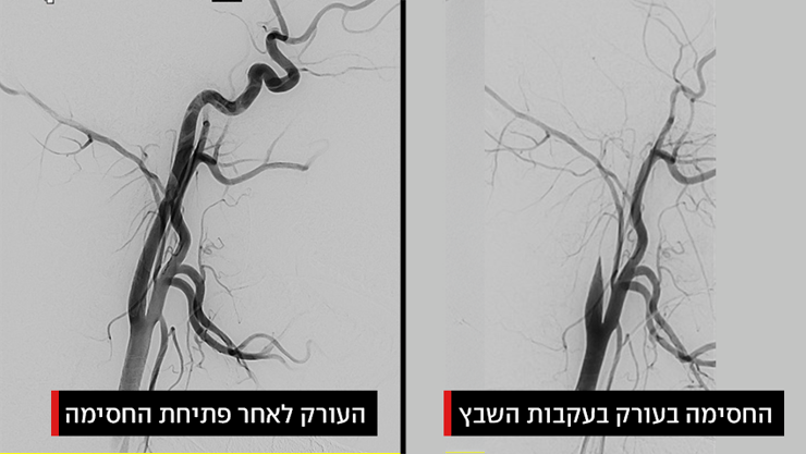העורק במוח של ש' לפני ואחרי שפתחו את החסימה שהייתה בו כתוצאה מהגידול (צילום: שערי צדק ) העורק במוח של ש' לפני ואחרי שפתחו את החסימה