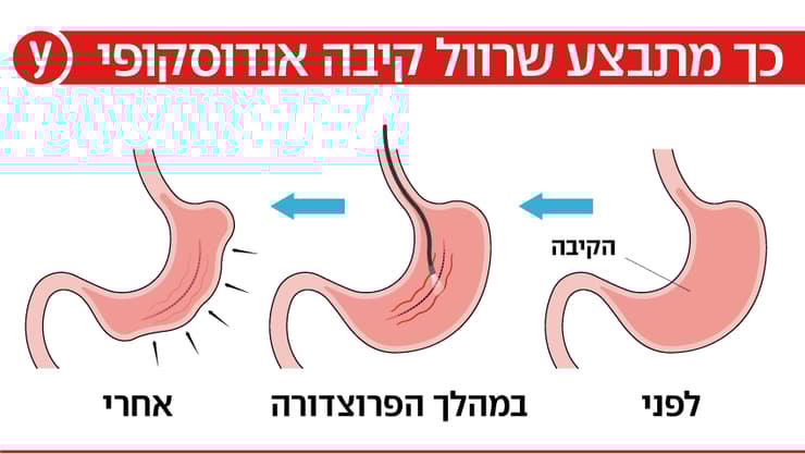 שרוול קיבה אנדוסקופי שרוול קיבה אנדוסקופי