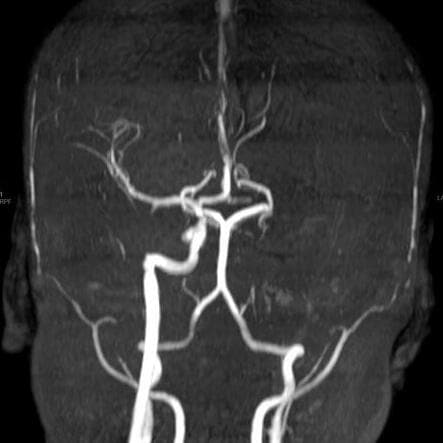 בתמונה מימין: האזור שלא קיבל אספקת דם בגלל השבץ המוחי (צילום: שערי צדק) אירוע מוחי שקיבלה נערה