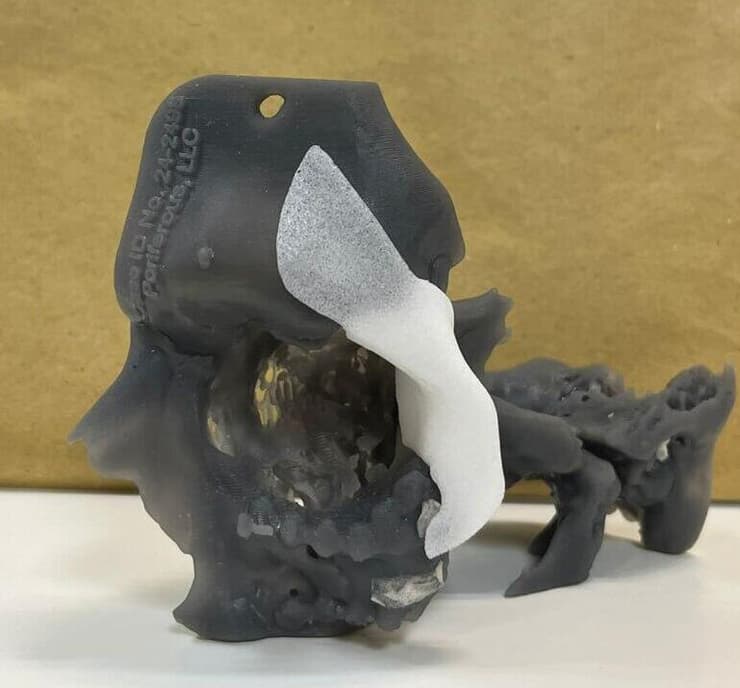 המשתל שהושתל בגולגולת של סער (צילום: המרכז הרפואי סורוקה) משתל לגולגולת סער גנור סורוקה