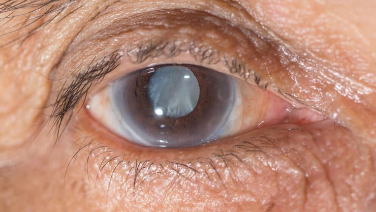 זו לא גזירת גורל: המחלה שפוגעת בראייה בגילאים מתקדמים