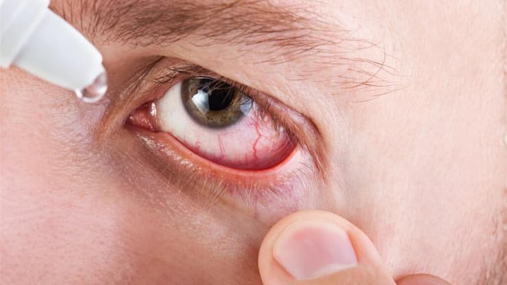 יובש בעיניים (צילום: shutterstock) יובש בעיניים