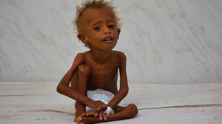 תימן 2016. עלייה של 34% במספר הילדים שסובלים מתת-תזונה תוך שנה