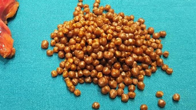 בין גורמי הסיכון: אבנים בכיס המרה (צילום: shutterstock) בין גורמי הסיכון: אבנים בכיס המרה