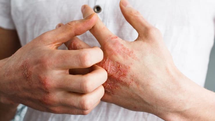 בקרב המחלות הדלקתיות הנלוות לפסוריאזיס נמצא כי נשים מצויות בסיכון גבוה יותר לפתח מחלות מעי דלקתיות