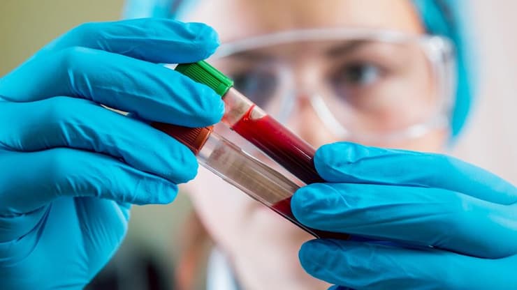 בדיקת דם חדשנית לאבחון אלצהיימר: פחות פולשנית ויותר מדויקת