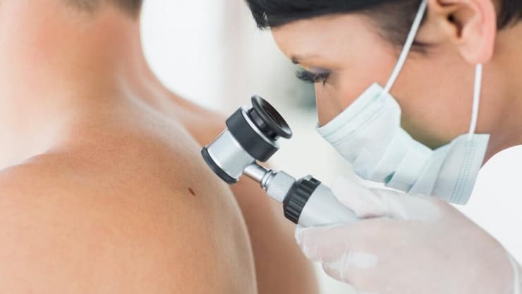 מלנומה נחשבת לסוג המסוכן ביותר של סרטן העור (צילום: Shutterstock) מלנומה נחשבת לסוג המסוכן ביותר של סרטן העור