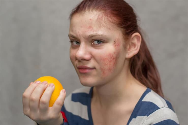 אטופיק דרמטיטיס