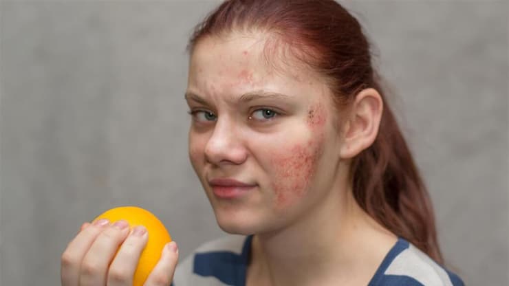 אטופיק דרמטיטיס