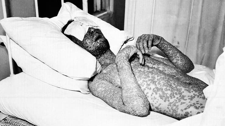 המחלה שנחשבה לאחת הקטלניות בהיסטוריה האנושית: אבעבועות שחורות (צילום: AP) חולה באבעבועות שחורות