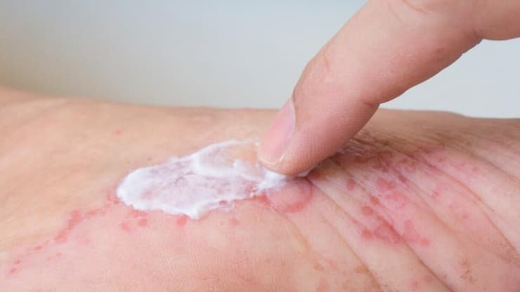 מטרת הטיפולים הקיימים היא להפחית את התסמינים, לשלוט בדלקת ולשפר את איכות החיים 