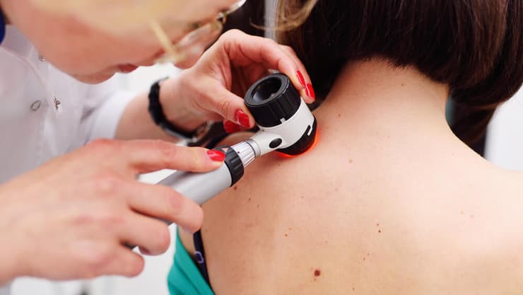 בדיקות תקופתיות אצל רופא עור חשובות לאיתור מוקדם של שינויים חשודים ונגעים בעור (Shutterstock) בדיקה מלנומה סרטן העור עור