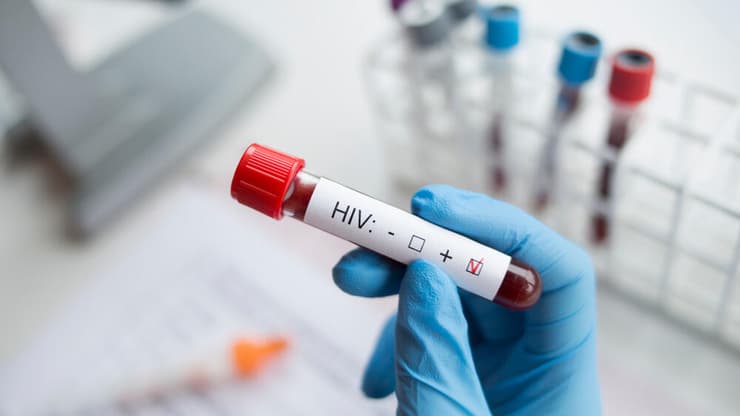 איידס HIV בדיקת דם