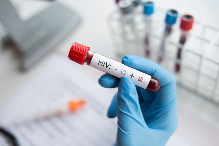 איידס HIV בדיקת דם