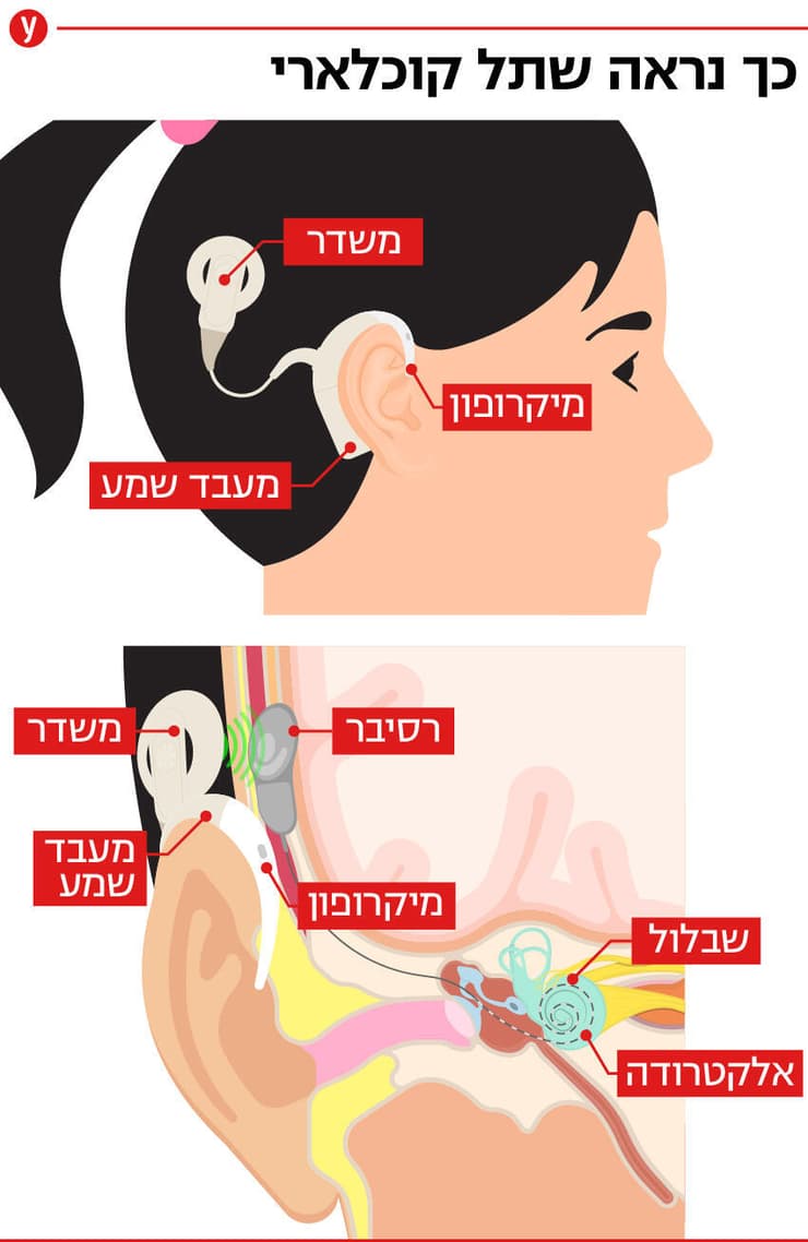 שתל שבלול שתל קוכליארי שמיעה אוזן
