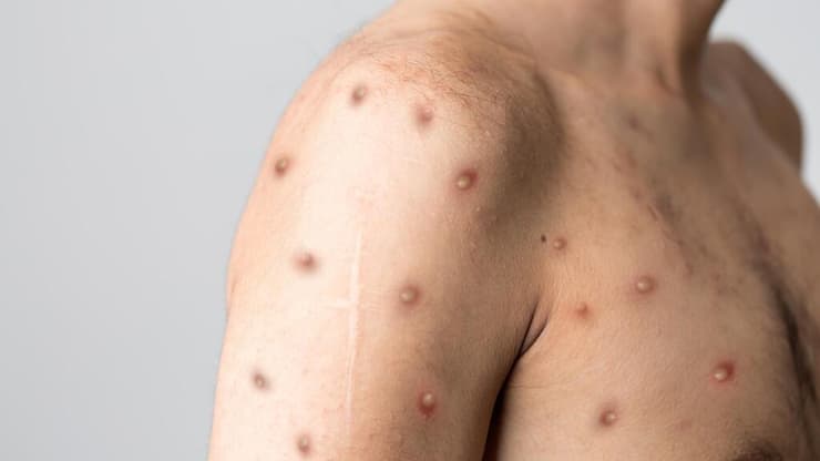 חולה באבעבועות הקוף, אילוסטרציה