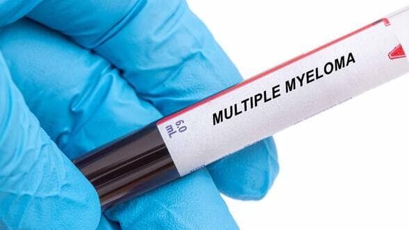 מיאלומה נפוצה